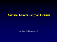 cervical laminectomy and fusion