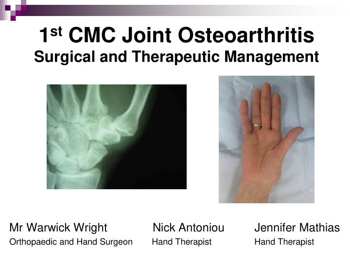 1 st cmc joint osteoarthritis