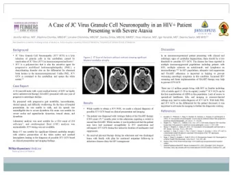 Background  JC Virus Granule Cell Neuronopathy (JCV GCN) is a lytic    infection of granule