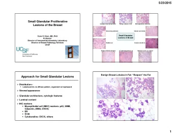 5/23/2015  Small Glandular Proliferative  Complex sclerosing lesion  Benign lobules in fat
