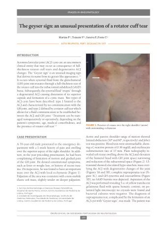 The geyser sign: an unusual presentation of a rotator cuff tear Martins P 1,2 , Teixeira V 1,2 ,