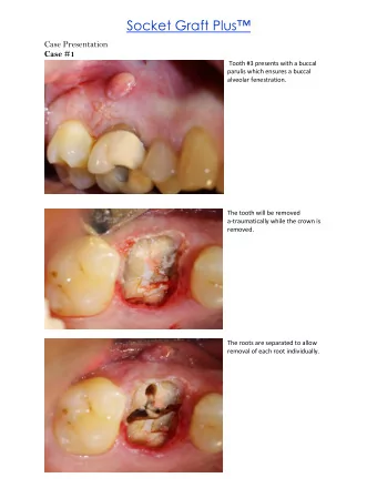 Socket Graft Plus   Case Presentation  Case #1  Tooth #3 presents with a buccal  parulis which