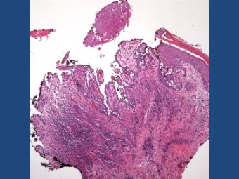 Pemphigus Vulgaris  Pearls  Suprabasilar  acantholysis  Extension along adnexal  epithelium