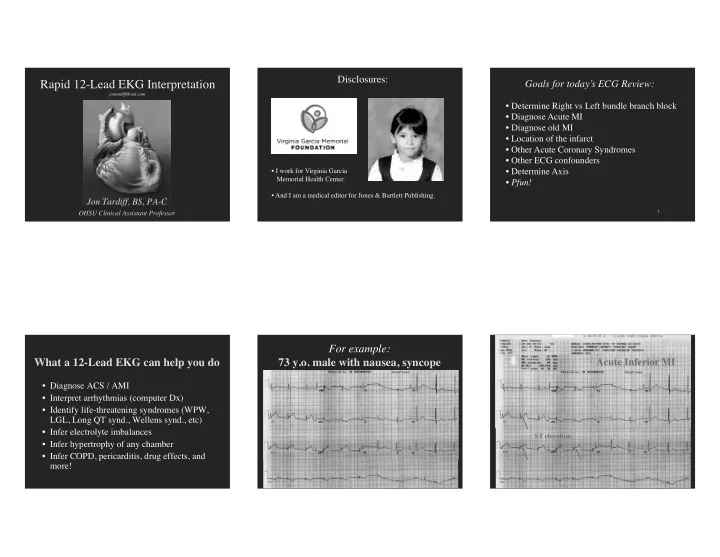 acute inferior mi