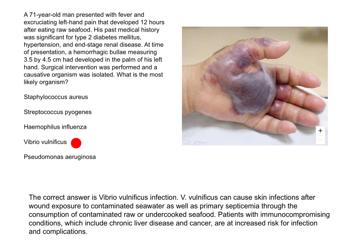 the correct answer is vibrio vulnificus infection v