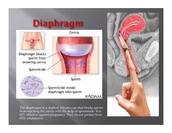 The diaphragm is a shallow silicone cup that blocks sperm  from reaching the cervix with the help