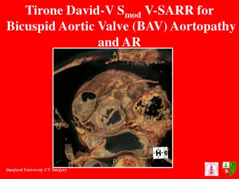 Tirone David-V S mod V-SARR for  Bicuspid Aortic Valve (BAV) Aortopathy  and AR  Stanford