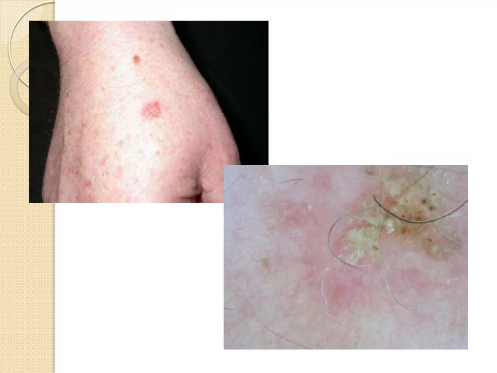 the skin clinic marlborough invasive scc