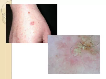 The Skin Clinic Marlborough  Invasive SCC  The Skin Clinic Marlborough  The Skin Clinic Marlborough