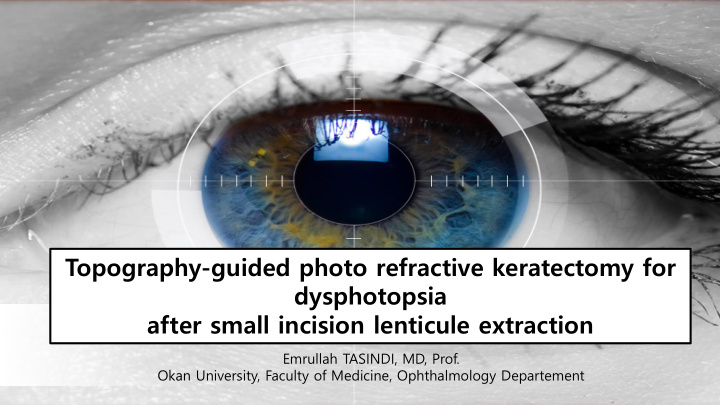 topography guided photo refractive keratectomy for