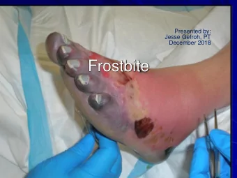 Frostbite  Objectives  Physiology of Frostbite  Stages of Care  Recommendations for Optimal Healing