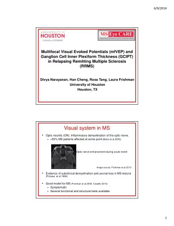 Visual system in MS    Optic neuritis (ON): Inflammatory demyelination of the optic nerve.