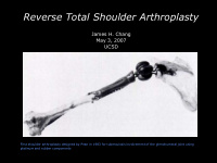reverse total shoulder arthroplasty