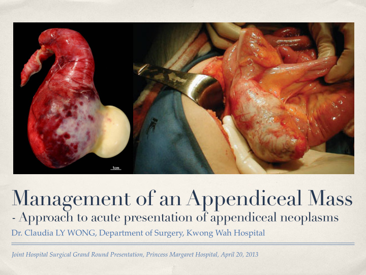 management of an appendiceal mass