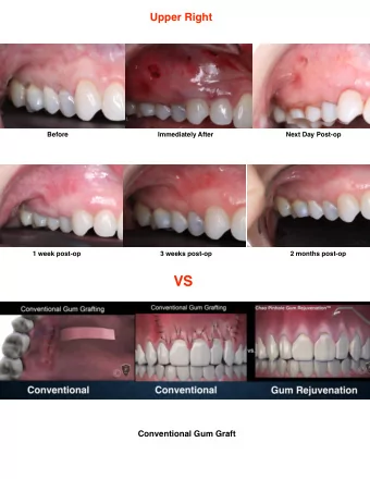 VS  Conventional Gum Graft    Upper Anteriors  Before  Next day  Immediately after  1 week
