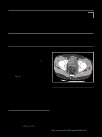 C  lear cell sarcoma of the kidney (CCSK), histori-  cally known as the bone metastasizing renal
