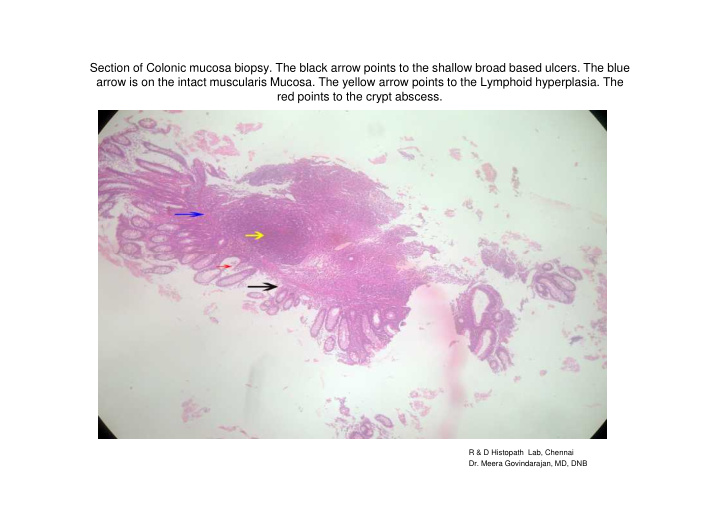 section of colonic mucosa biopsy the black arrow points