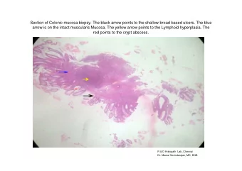 Section of Colonic mucosa biopsy. The black arrow points to the shallow broad based ulcers. The
