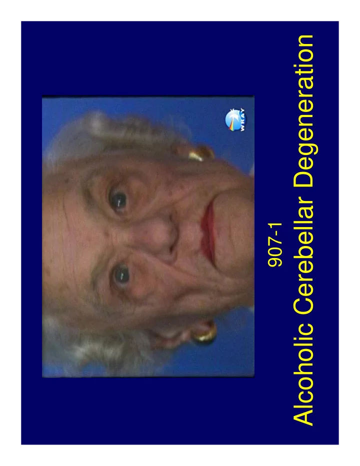 alcoholic cerebellar degeneration