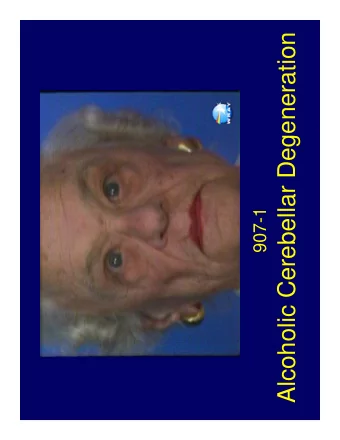 Alcoholic Cerebellar Degeneration  907-1  Clinical Syndrome  The clinical syndrome of alcoholic