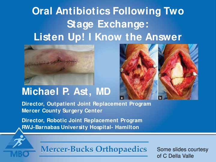 oral antibiotics following two stage exchange listen up i