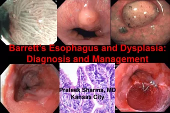 Barretts Esophagus and Dysplasia:  Diagnosis and Management  Prateek Sharma, MD  Kansas City