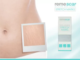 Breast  Abdomen  Arms  Stretch marks can appear anywhere on the body,  but are most likely to