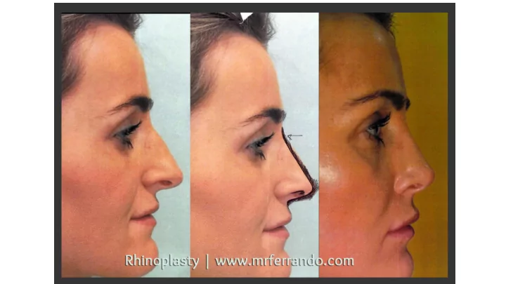 rhinoplasty result