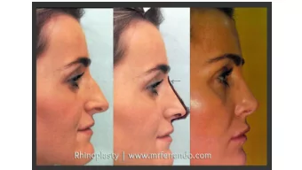 Rhinoplasty Result  After a year  From the surgery  Rhinoplasty Result  After a year  From the