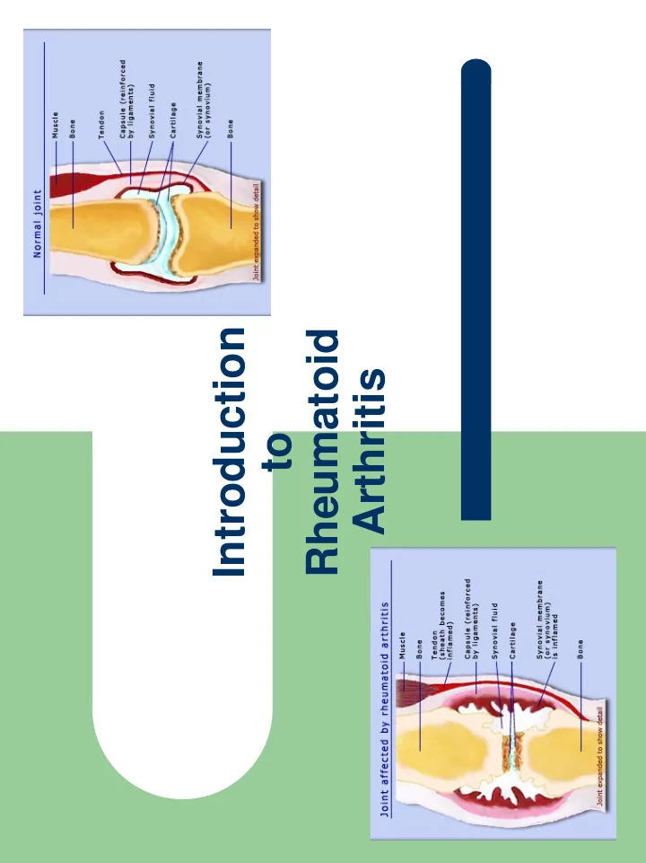 introduction rheumatoid arthritis to what is rheumatoid