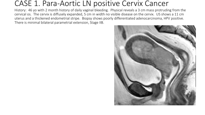 case 1 para aortic ln positive cervix cancer