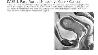 CASE 1. Para-Aortic LN positive Cervix Cancer  History:  46 yo with 2 month history of daily