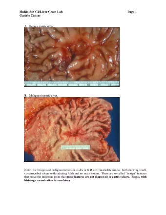 HuBio 546 GI/Liver Gross Lab  Page 1 Gastric Cancer A. Benign gastric ulcer. B. Malignant gastric