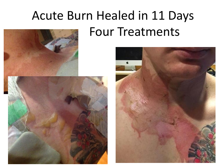 acute burn healed in 11 days four treatments