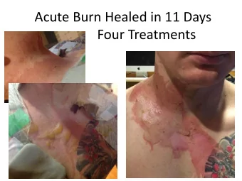 Acute Burn Healed in 11 Days  Four Treatments  Acute Burn Healed in 11 Days  Four Treatments  4 FSM
