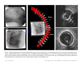 RAO  45mm  LAO  35mm  Figure 1: Biplane angiograms of a stenosed human right coronary artery imaged