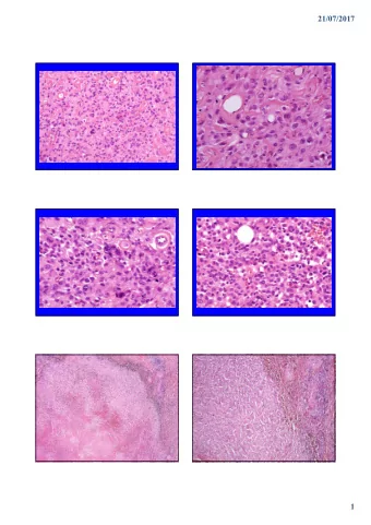 21/07/2017  1  21/07/2017  CD31  ERG  2  21/07/2017  SPINDLE CELL  SPINDLE CELL  HAEMANGIOMA