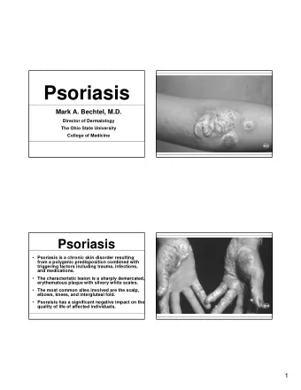 Psoriasis  Mark A. Bechtel, M.D.  Director of Dermatology  The Ohio State University  College of