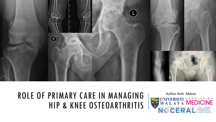 hip knee osteoarthritis