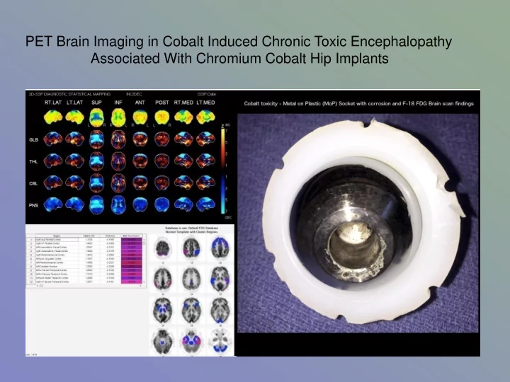 pet brain imaging in cobalt induced chronic toxic