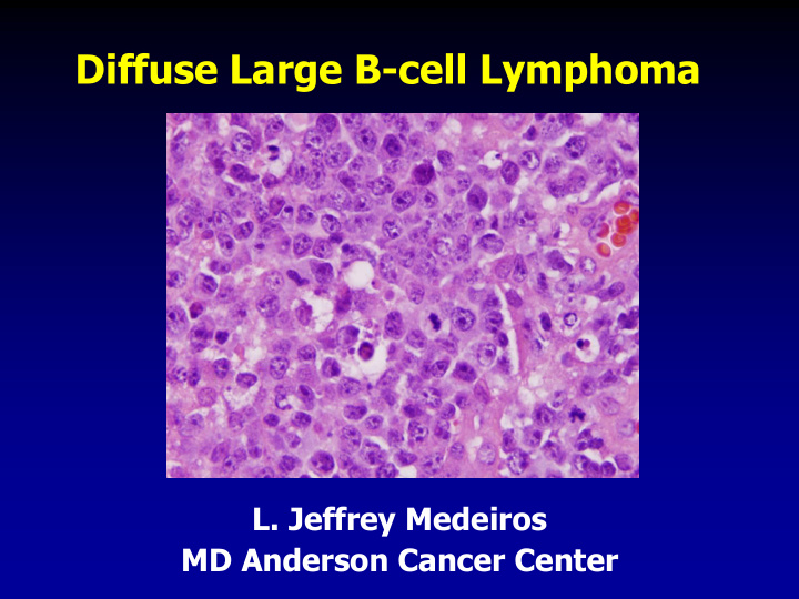 diffuse large b cell lymphoma