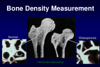 bone density measurement