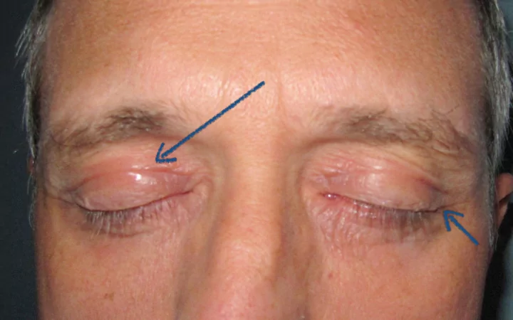 washing my eyelids