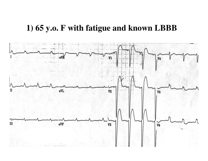 1 65 y o f with fatigue and known lbbb 1 65 y o f with