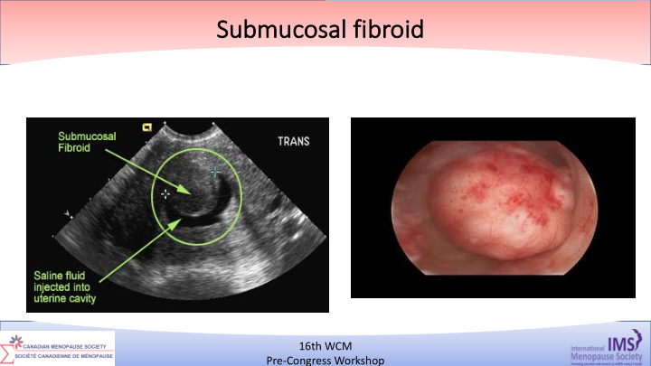 su submucosa sal fibroid
