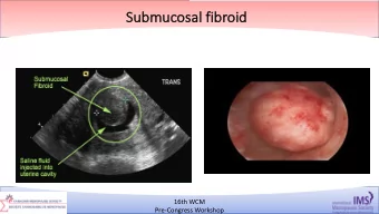 Su  Submucosa  sal fibroid  16th WCM  6/4/18  119  Pre-Congress Workshop  16th WCM  6/4/18  120