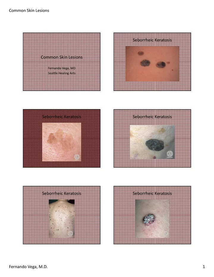 seborrheic keratosis common skin lesions