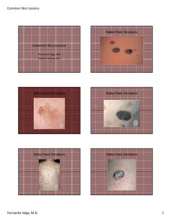 Seborrheic Keratosis Common Skin Lesions Fernando Vega, MD Seattle Healing Arts  Seborrheic