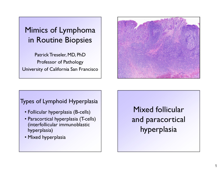 mimics of lymphoma in routine biopsies