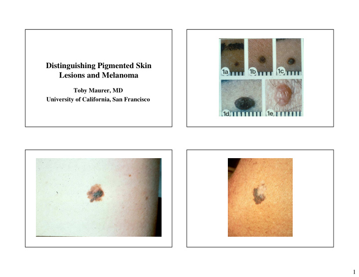 distinguishing pigmented skin lesions and melanoma